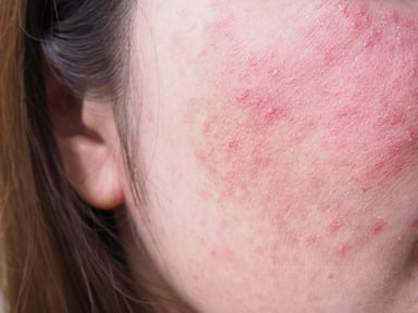 stock-photo-red-rash-on-young-asian-thai-nainen-kasvot-itikoiden-ja-allergisten-iho-ongelmien-ihotulehdus_shutterstock_1953028711 web pienempi