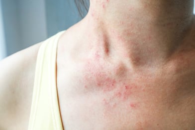 stock-photo-young-woman-has-reactive-skin-rash-itch-on-neck_shutterstock_1017422944 web pienempi