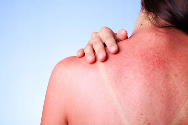 woman_Shoulder_sunburn_red_shutterstock_1224030637_smaller