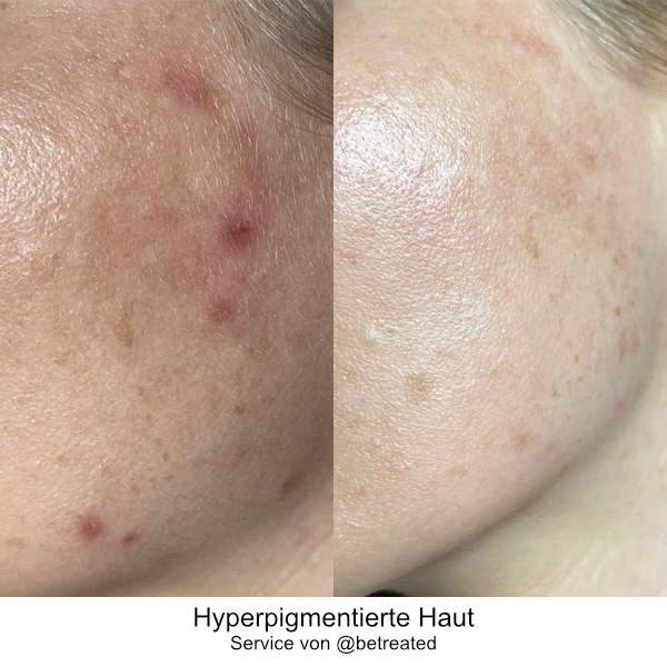 Hyperpigmentierte Haut DE 