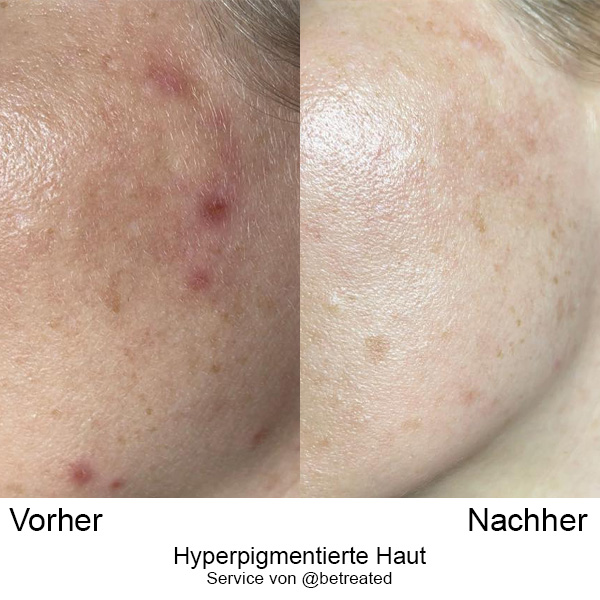 Hyperpigmentierte Haut DE_