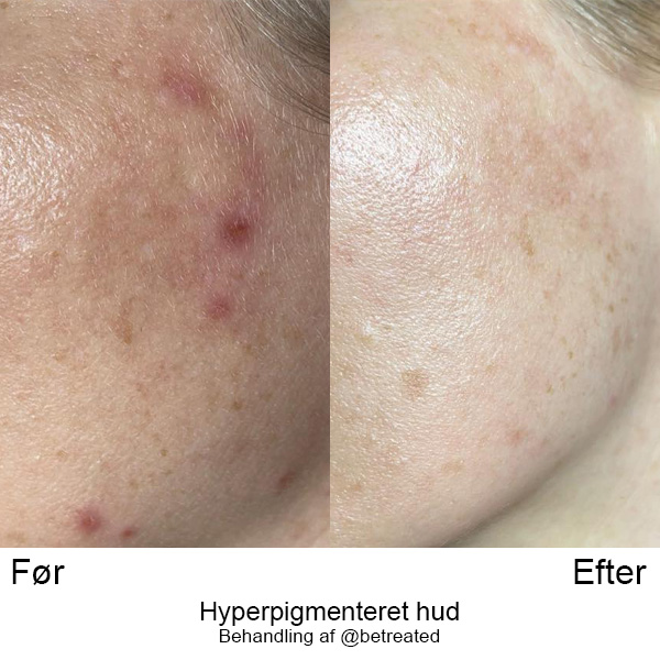 DK Hyperpigmenteret hud