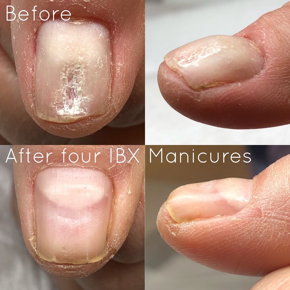 IBX_BeforeAfter_After 4 treatments_deep cut