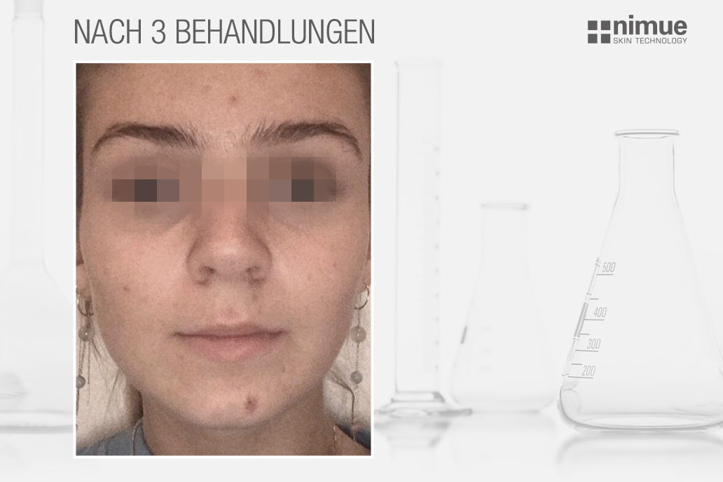 NMU_before-after_v2_After-3-Treatments_DACH