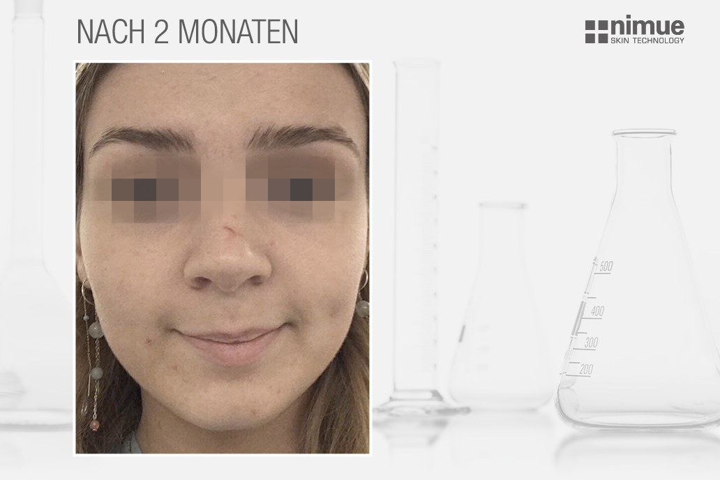 NMU_before-after_v2_After_DACH