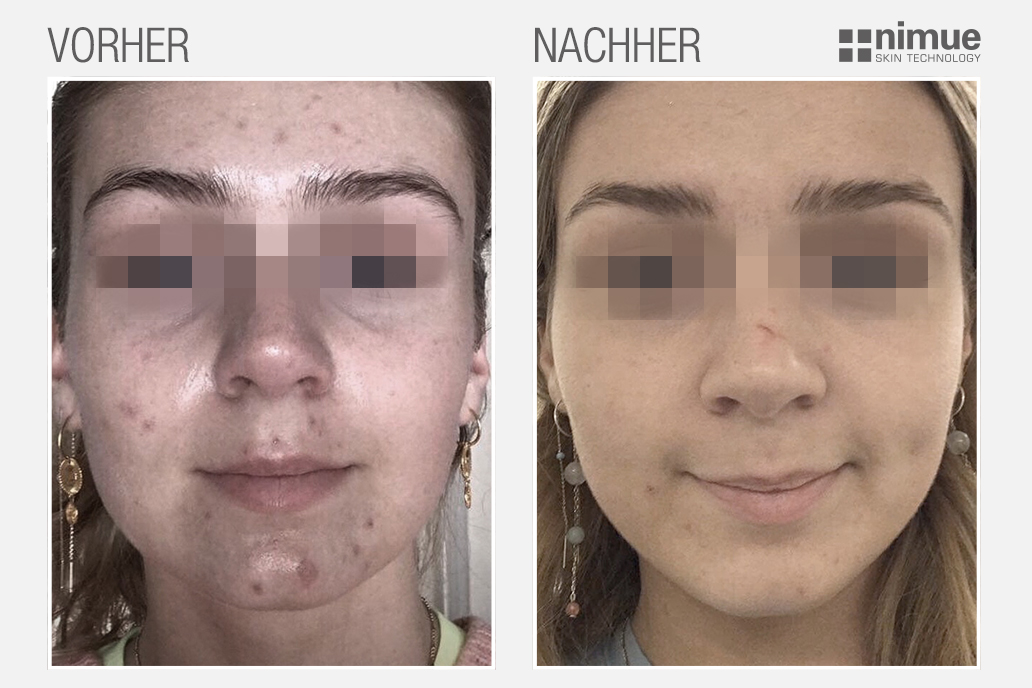 NMU_before-after_v2_Before-After_DACH