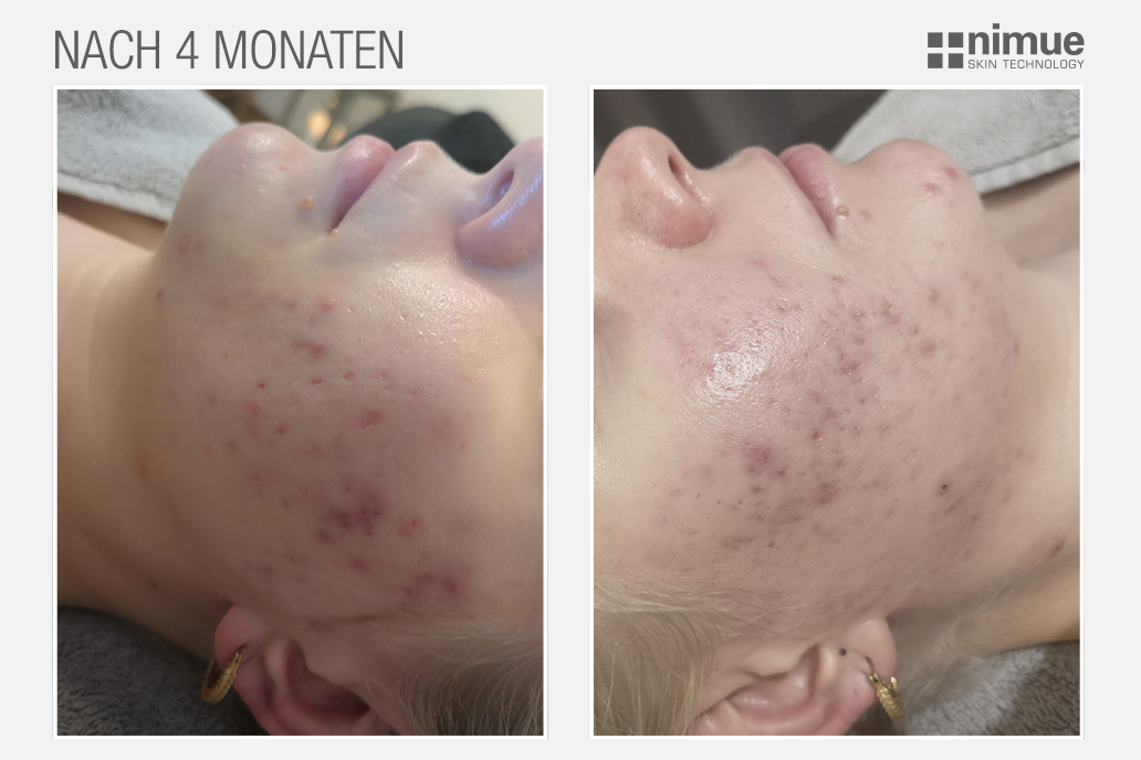 NM_before-after_v3_After-4-Months_DACH
