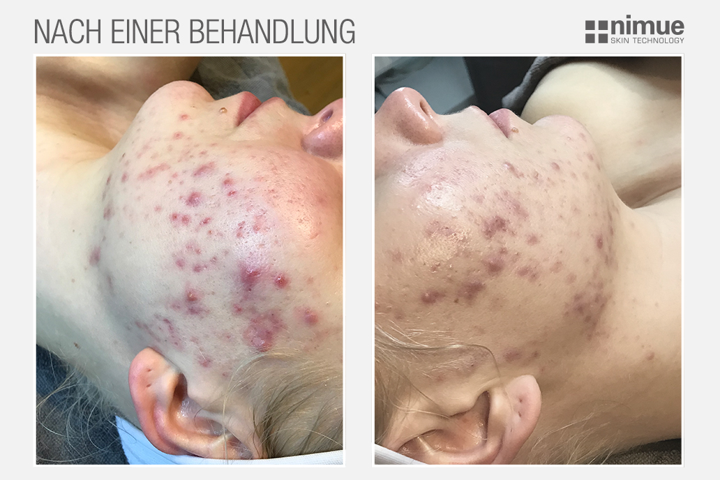 NM_before-after_v3_After-One-Treatment_DACH