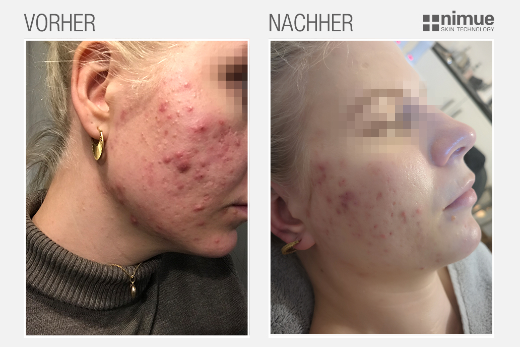 NM_before-after_v3_Before-After_DACH-1