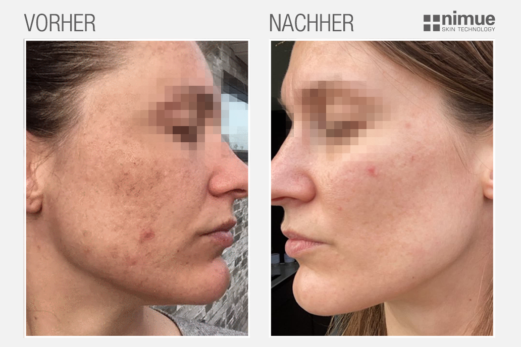 NMU_before-after-right-side_v4_DACH